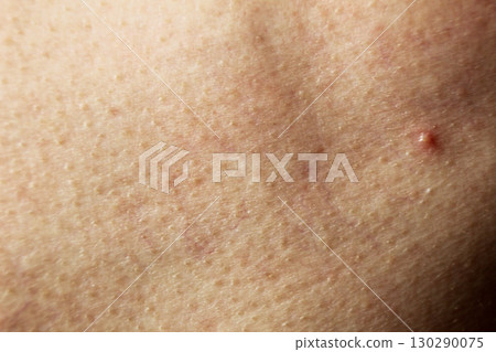 Pimple inflammation on the skin close-up. Acne treatment Pimple inflammation on the skin close-up. Acne treatment 130290075