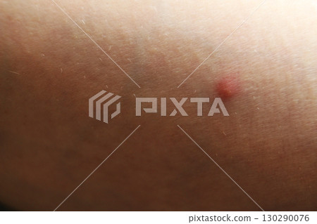 a red inflamed pimple on the skin. Acne treatment a red inflamed pimple on the skin. Acne treatment 130290076