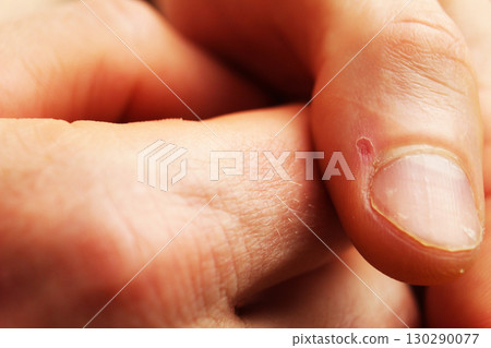 Wound on the burrs of a finger close-up Wound on the burrs of a finger close-up 130290077