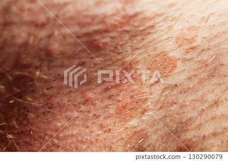 dark spots on the skin, swelling. Skin diseases dark spots on the skin, swelling. Skin diseases 130290079