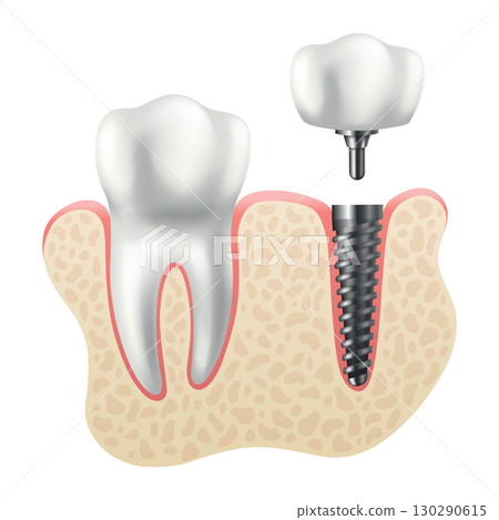 Dental implant structure. Medical educative infographic poster. Teeth implant, realistic vector design of dentistry. Implant screw, healthcare, dentist and orthodontist treatment 130290615