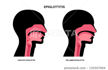 Epiglottitis medical poster Epiglottitis medical poster 130307804