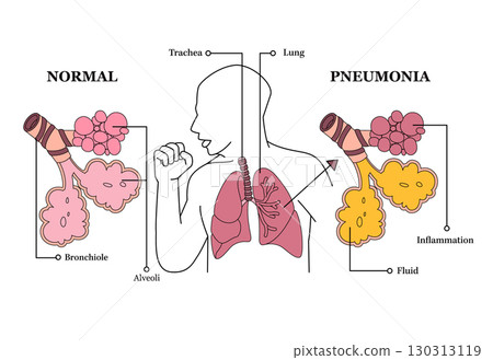 Medical illustration comparing a healthy lung and a lung with pneumonia normal bronchioles and alveoli inflamed and filled with fluid health effects of respiratory diseases vector 130313119