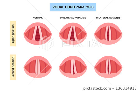 Vocal cords paralysis Vocal cords paralysis 130314915