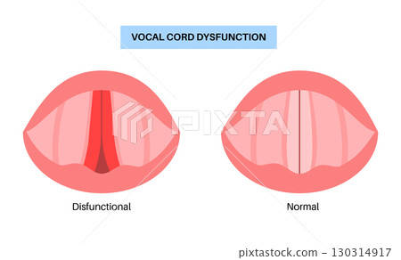 Vocal cords dysfunction Vocal cords dysfunction 130314917