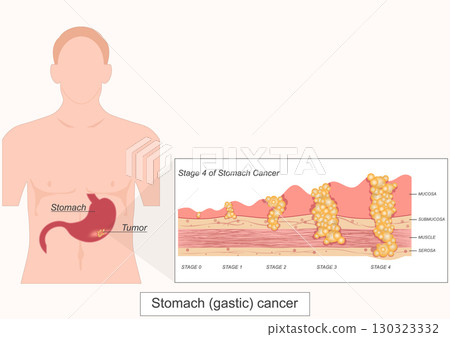 Stage4 of Stomach gastric cancer is cancer that start in the cells. 130323332