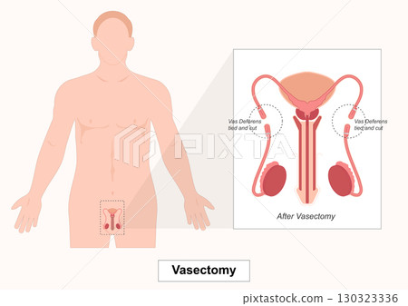 Vasectomy is a permanent surgical method of male birth control . 130323336