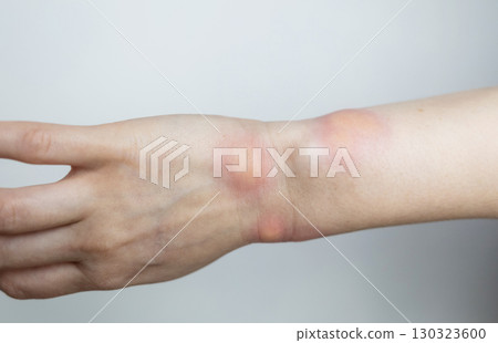 Close up of a swollen wrist with visible redness, inflammation, caused by an insect bite or allergic reaction. The hand signs of rash, itching, and local pain, typical of mosquito bites, bee stings 130323600