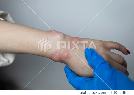 Close up of a swollen wrist with visible redness, inflammation, caused by an insect bite or allergic reaction. The hand signs of rash, itching, and local pain, typical of mosquito bites, bee stings 130323603