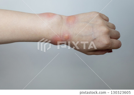 Close up of a swollen wrist with visible redness, inflammation, caused by an insect bite or allergic reaction. The hand signs of rash, itching, and local pain, typical of mosquito bites, bee stings 130323605
