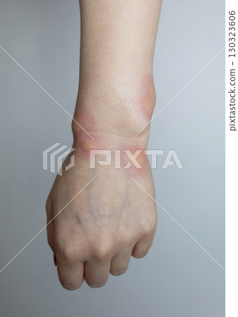 Close up of a swollen wrist with visible redness, inflammation, caused by an insect bite or allergic reaction. The hand signs of rash, itching, and local pain, typical of mosquito bites, bee stings 130323606