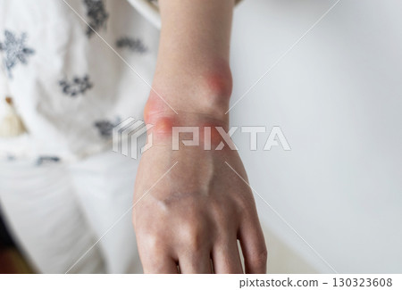 Close up of a swollen wrist with visible redness, inflammation, caused by an insect bite or allergic reaction. The hand signs of rash, itching, and local pain, typical of mosquito bites, bee stings Close up of a swollen wrist with visible redness, inflammation, caused by an insect bite or allergic reaction. The hand signs of rash, itching, and local pain, typical of mosquito bites, bee stings 130323608