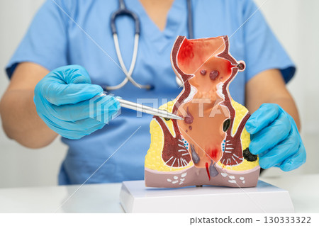 Asian doctor with rectum and hemorrhoid human anatomy model at hospital, inflamed vascular structure. Asian doctor with rectum and hemorrhoid human anatomy model at hospital, inflamed vascular structure. 130333322