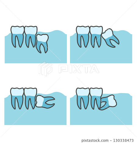 Illustration of how wisdom teeth are buried Illustration of how wisdom teeth are buried 130338473