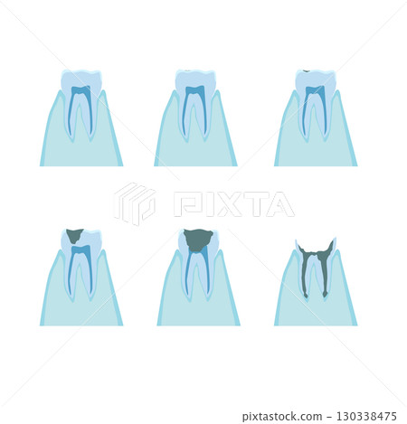 蛀牙進展的橫斷面圖 130338475