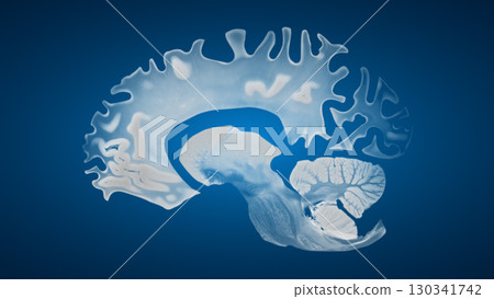 Sagittal Brain Showing Cortical Atrophy in Alzheimer Disease 130341742