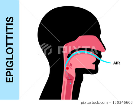 Epiglottitis medical poster 130346603