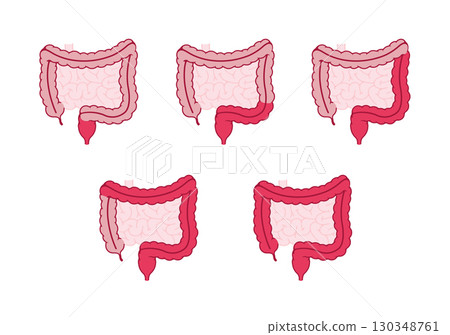 Types of ulcerative colitis (no text) Vector illustration 130348761