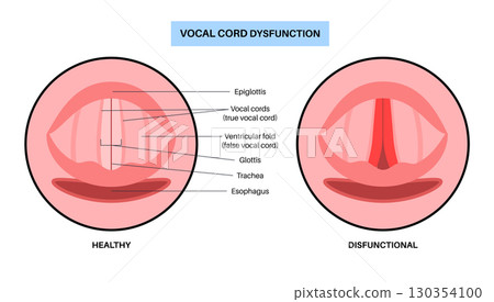 Vocal cords dysfunction Vocal cords dysfunction 130354100