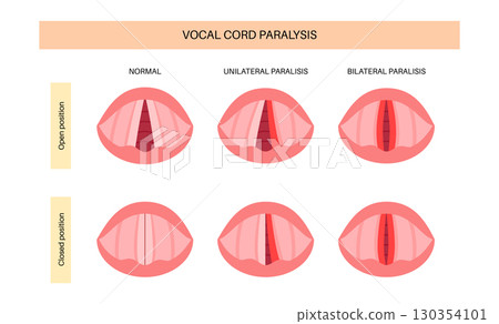 Vocal cords paralysis 130354101
