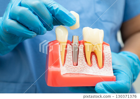 Dentist holding dental implant, artificial tooth roots into jaw, root canal of dental treatment, gum disease, teeth model for dentist. Dentist holding dental implant, artificial tooth roots into jaw, root canal of dental treatment, gum disease, teeth model for dentist. 130371376