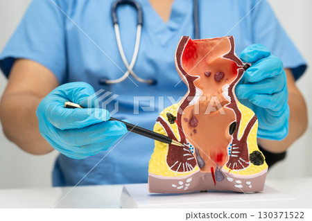 Asian doctor with rectum and hemorrhoid human anatomy model at hospital, inflamed vascular structure. Asian doctor with rectum and hemorrhoid human anatomy model at hospital, inflamed vascular structure. 130371522