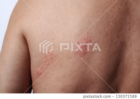 shingles outbreak on the upper back of a man shingles outbreak on the upper back of a man 130371589