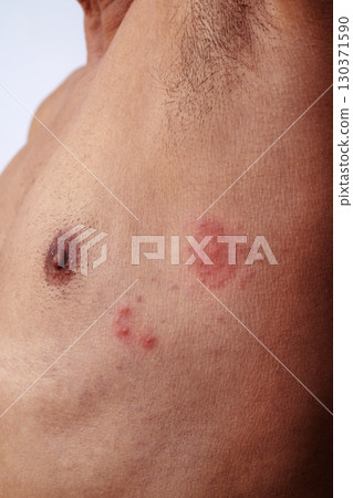 a man with shingles on his chest a man with shingles on his chest 130371590