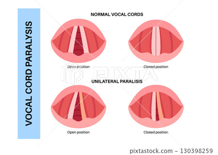 Vocal cords paralysis 130398259