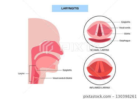 Laryngitis medical poster Laryngitis medical poster 130398261
