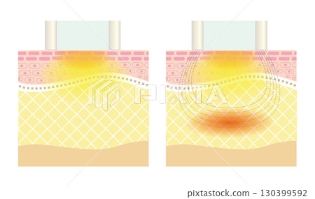 Cross-section of skin after Photo RF Facial 130399592
