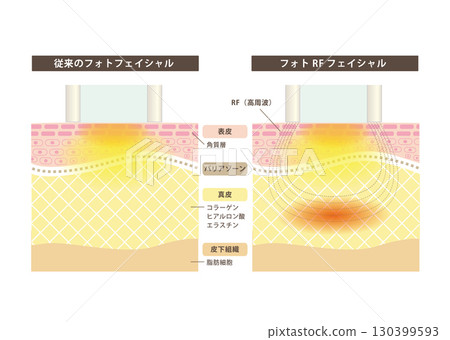 Cross-section of skin after Photo RF Facial 130399593