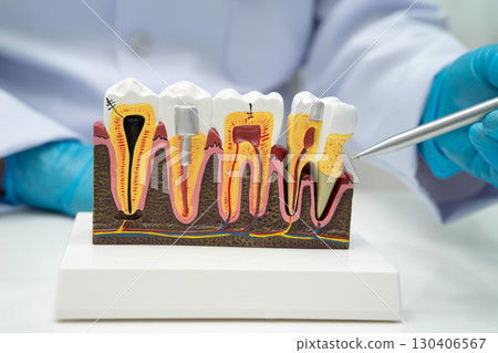 Dentist holding dental implant, artificial tooth roots into jaw, root canal of dental treatment, gum disease, teeth model for dentist. 130406567
