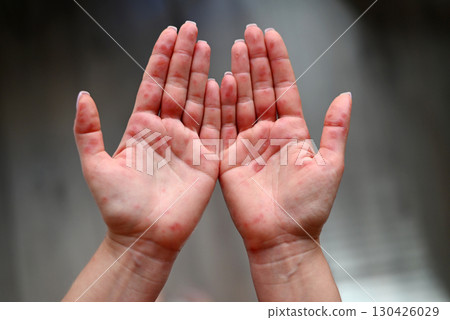 Close-up of human palms with red rash caused by Coxsackievirus, showing hand-foot-mouth disease symptoms. Close-up of human palms with red rash caused by Coxsackievirus, showing hand-foot-mouth disease symptoms. 130426029