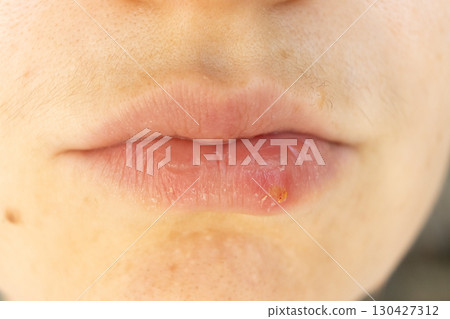 Macro Closeup of Herpes on Human Lip. 130427312