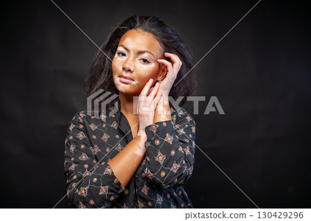 Young woman with vitiligo skin disorder looking at 130429296