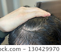 Scalp of people suffering from seborrheic dermatitis, dandruff, and thinning hair 130429970