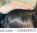 Scalp of people suffering from seborrheic dermatitis, dandruff, and thinning hair 130429971