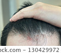 The hairline of someone with seborrheic dermatitis (the scalp of someone suffering from dandruff or thinning hair) 130429972