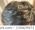 Dandruff-ridden hair (people suffering from seborrheic dermatitis, dandruff, and thinning hair) 130429973