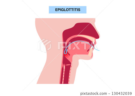 Epiglottitis medical poster Epiglottitis medical poster 130432039