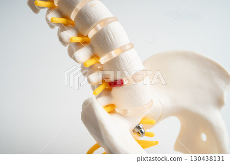 Lumbar spine displaced herniated disc fragment, spinal nerve and bone. Model for treatment medical in the orthopedic department. 130438131