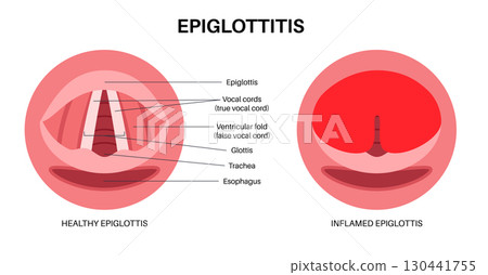 Epiglottitis medical poster Epiglottitis medical poster 130441755