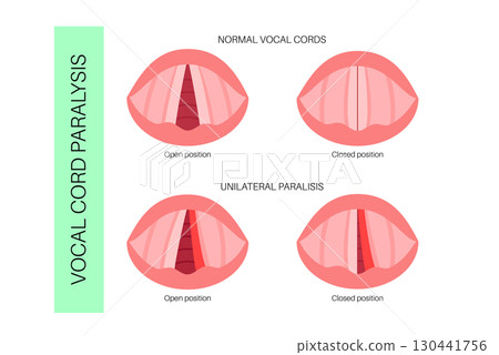 Vocal cords paralysis 130441756
