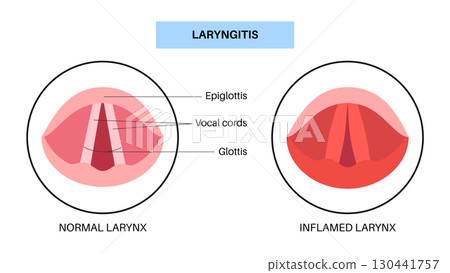 Laryngitis medical poster 130441757