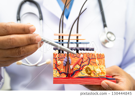 Hair transplant, Asian dermatologist doctor holding skin structure anatomy model for treatment in hospital. Hair transplant, Asian dermatologist doctor holding skin structure anatomy model for treatment in hospital. 130444845