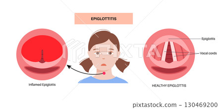 Epiglottitis medical poster Epiglottitis medical poster 130469200