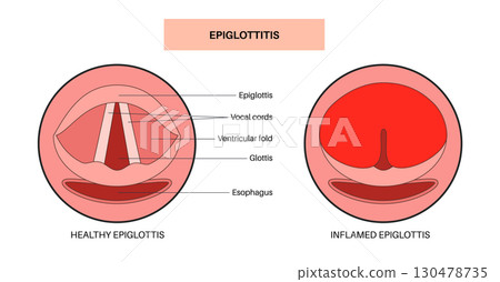 Epiglottitis medical poster 130478735