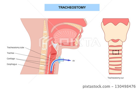 Tracheostomy medical poster Tracheostomy medical poster 130498476