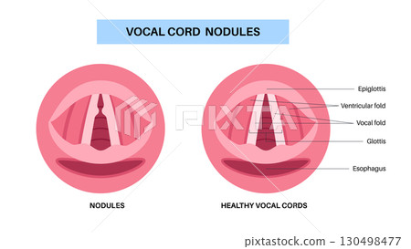 Vocal cord nodules Vocal cord nodules 130498477